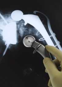 biomet metal hip settlement, biomet hip settlement, biomet metal on metal hip, hip implant failure
