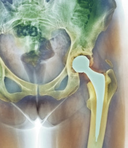 DePuy ASR Hip Implant, metal-on-metal hip implant, hip implant failure
